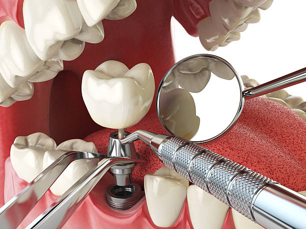 Best Emergency Tooth Extraction in Lake Wildwood, CA